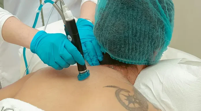 What Actually Happens to Your Skin During Laser Tattoo Removal