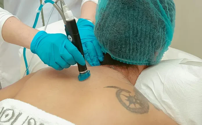 What Actually Happens to Your Skin During Laser Tattoo Removal What Actually Happens to Your Skin During Laser Tattoo Removal